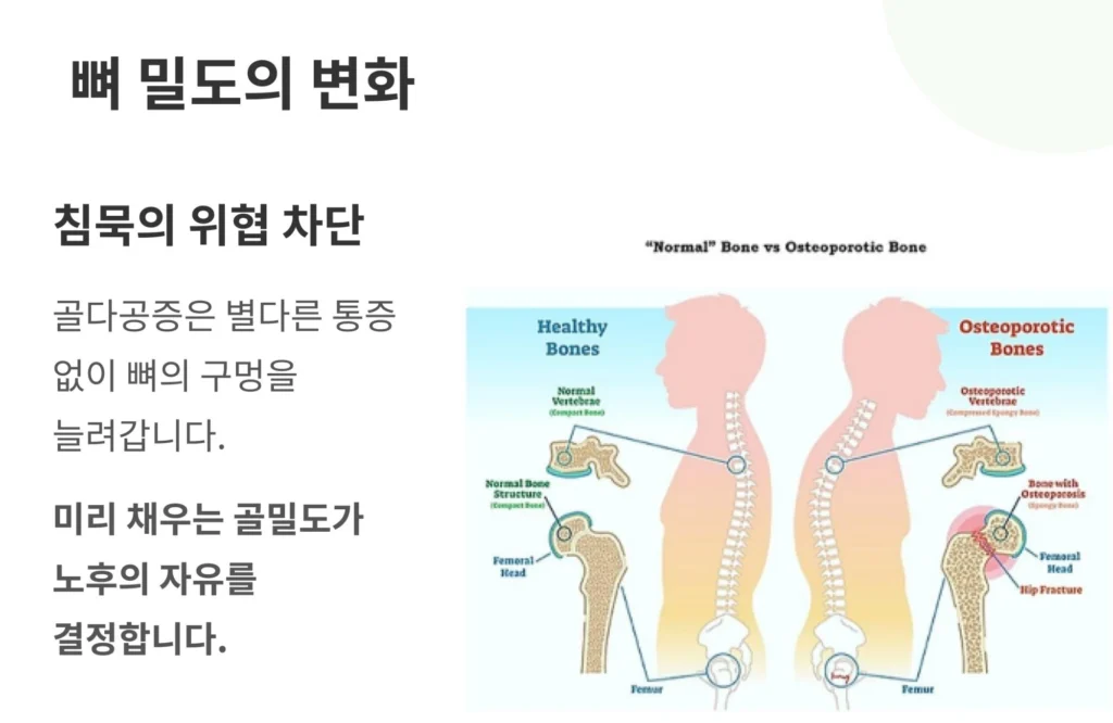 정상적인 뼈와 골다공증이 진행된 뼈의 구조를 비교하는 일러스트. 골밀도 관리의 중요성과 노후의 자유를 결정하는 뼈 건강에 대한 메시지.