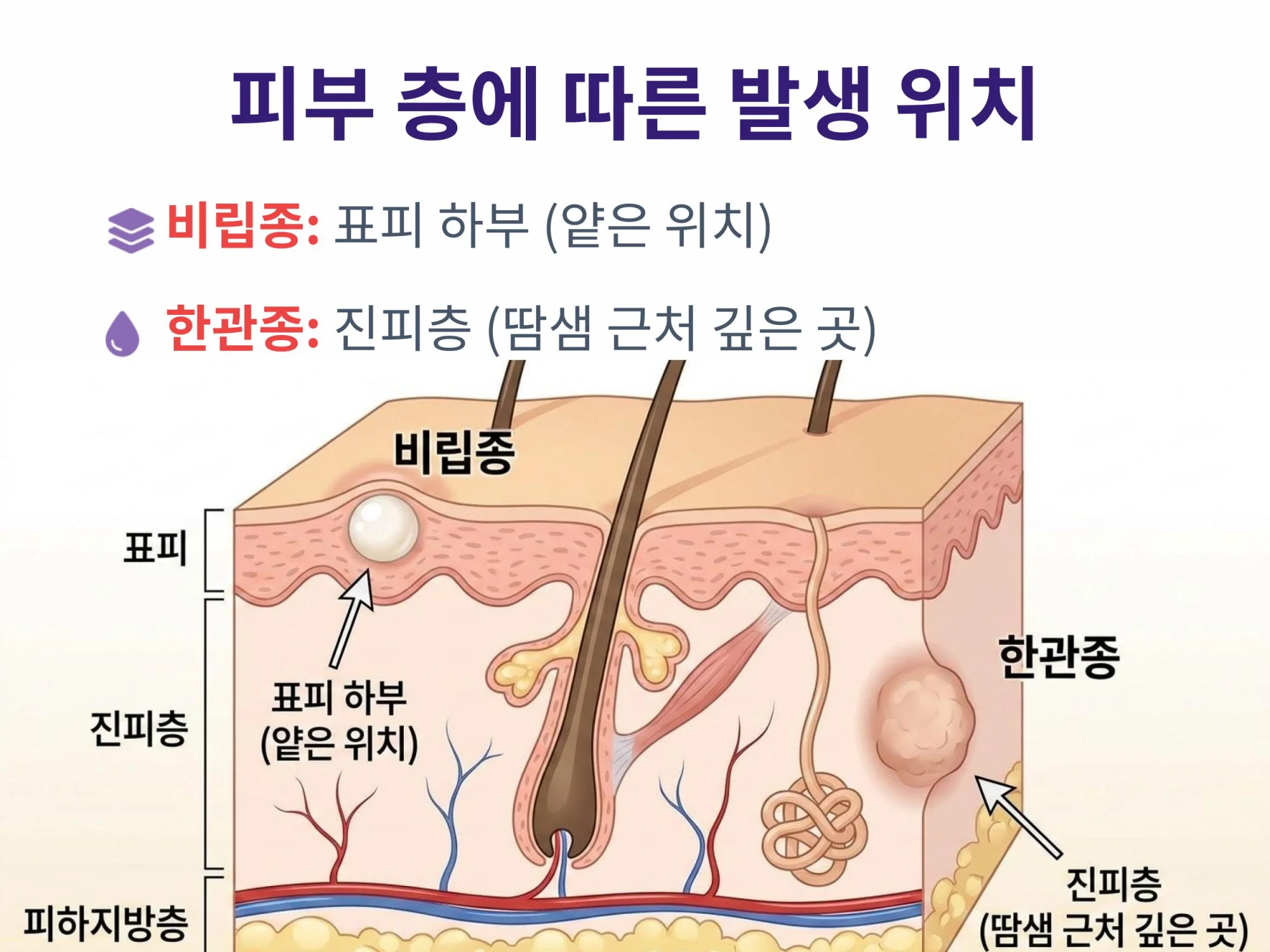 피부 단면도를 통해 본 표피층 비립종과 진피층 한관종의 발생 깊이 차이 설명