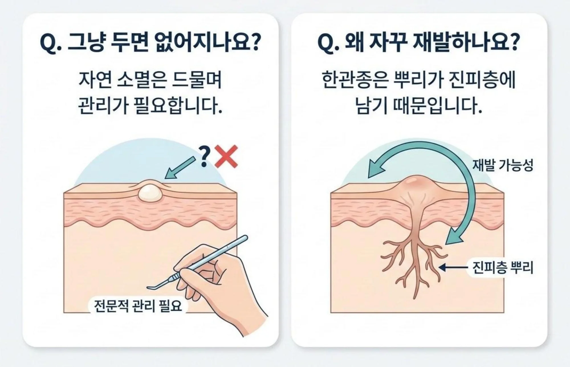 비립종의 자연 소멸 여부와 한관종의 깊은 진피층 뿌리로 인한 재발 가능성 설명 일러스트