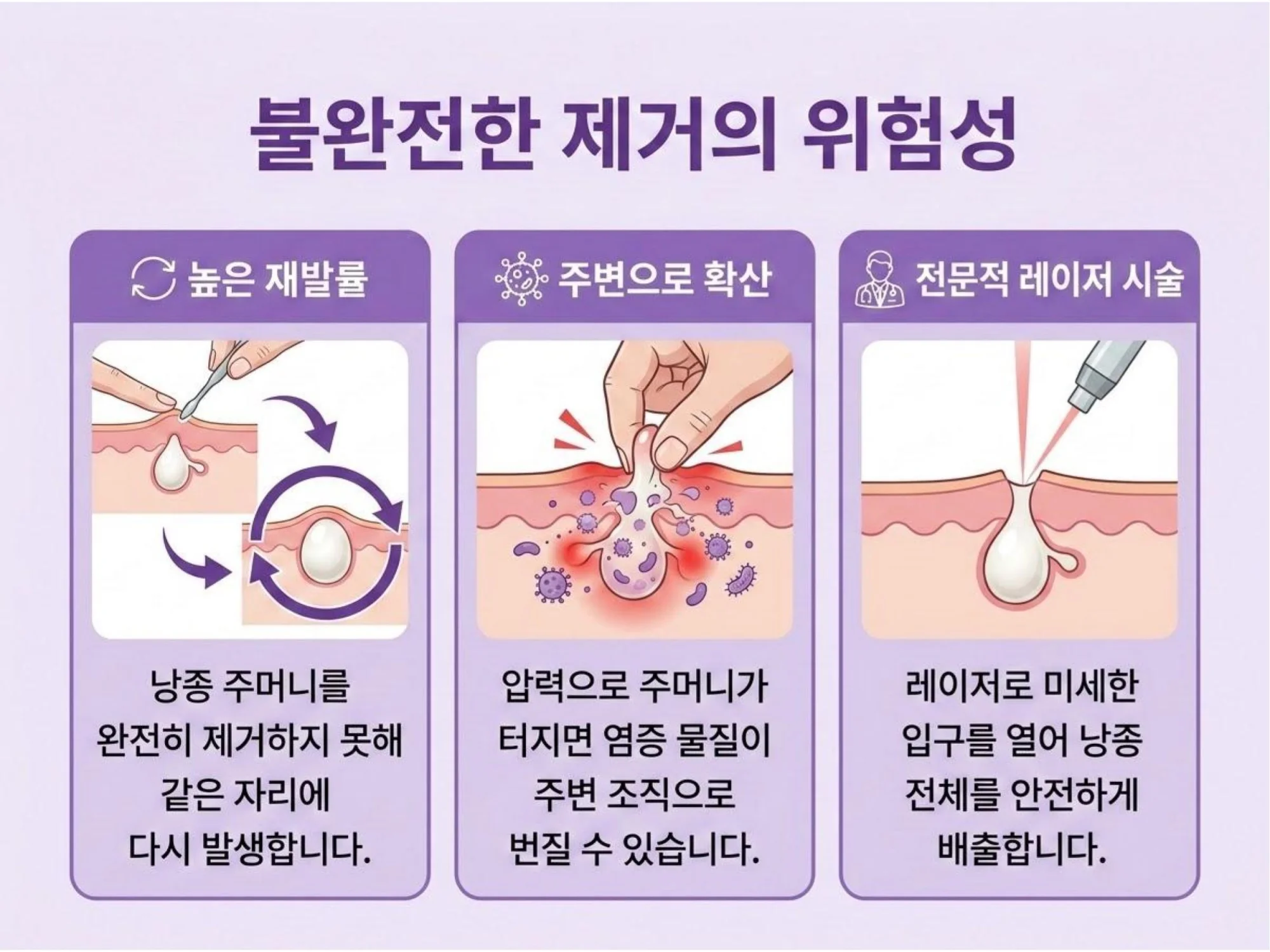 자가 제거 시 불완전한 낭종 추출의 위험성: 높은 재발률과 염증 확산 문제 및 전문적인 레이저 시술의 안전성 비교