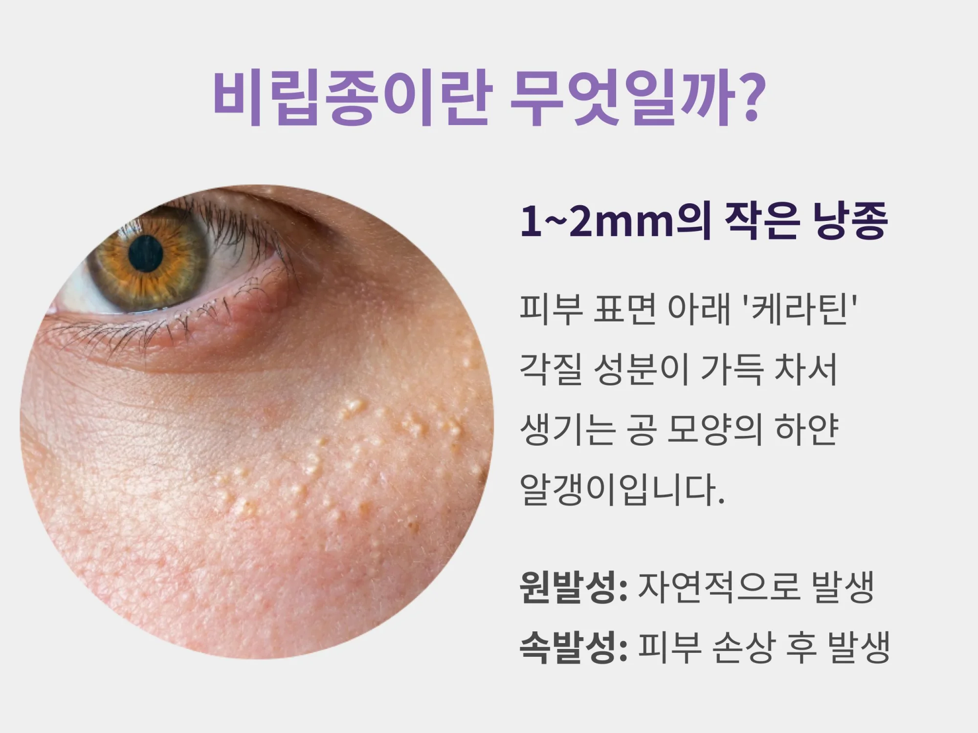 비립종의 정의와 특징 설명 이미지: 피부 표면 아래 케라틴 각질이 찬 1~2mm 크기의 하얀 알갱이와 원발성, 속발성 비립종 구분