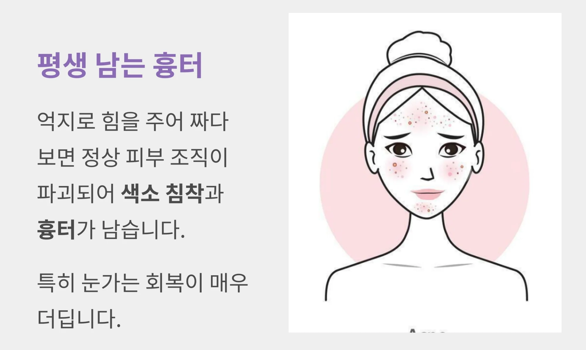 잘못된 비립종 압출로 인한 피부 흉터와 색소 침착 위험 안내: 특히 회복이 더딘 눈가 피부 조직 파괴 주의 사항