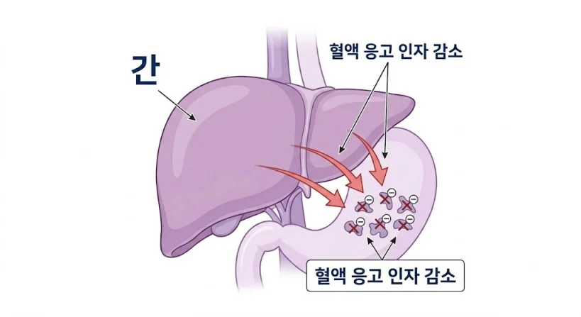 간 기능 저하와 혈액 응고 인자 감소의 관계 도식