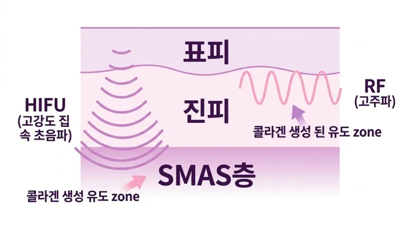 표피, 진피, SMAS층까지 도달하는 HIFU 초음파와 RF 고주파의 콜라겐 생성 유도 작용 원리 일러스트