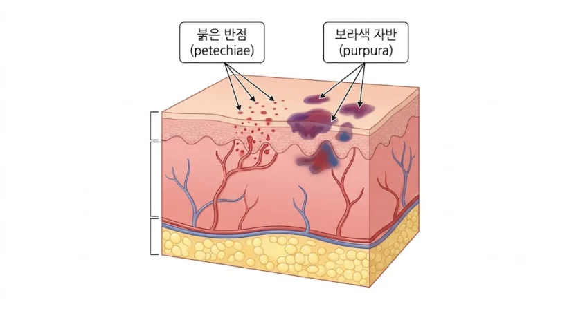 혈소판 감소증 피부 반점 및 자반증 의학적 도식