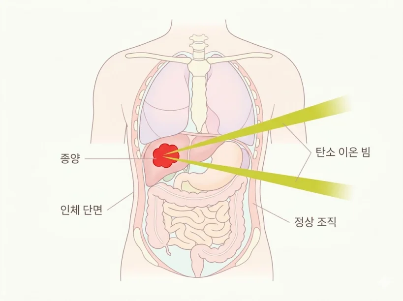 중입자 탄소 이온 빔 종양 조사 원리 의학 일러스트