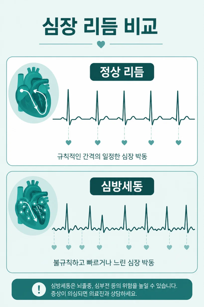 심방세동과 정상 심장 리듬을 비교한 일러스트
