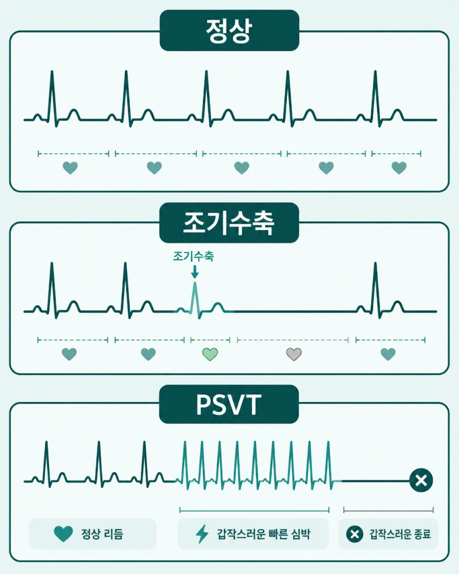 정상 심장 리듬과 조기수축·PSVT 패턴을 비교한 일러스트