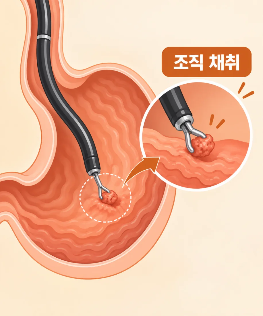 내시경으로 위 점막 조직을 채취하는 과정 의학 일러스트