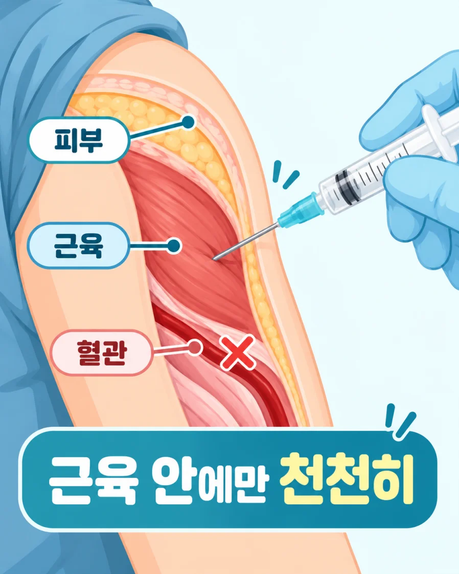 근육 안에만 천천히 놓는 근육주사 과정을 표현한 의학 일러스트